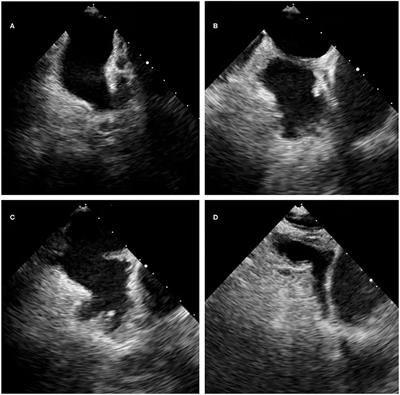 The Association of Left Atrial Appendage Morphology to Atrial Fibrillation Recurrence After Radiofrequency Ablation